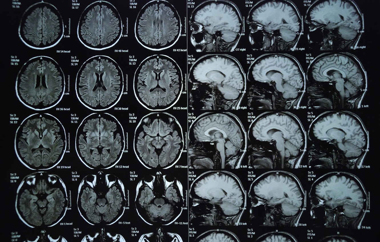 Photo Wallpaper Sake, Brain, X-rays - Brain X Ray - HD Wallpaper 