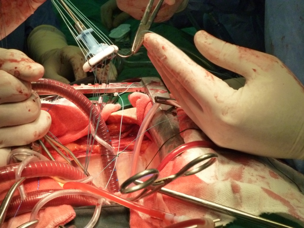 Open Heart Surgery Operation - HD Wallpaper 