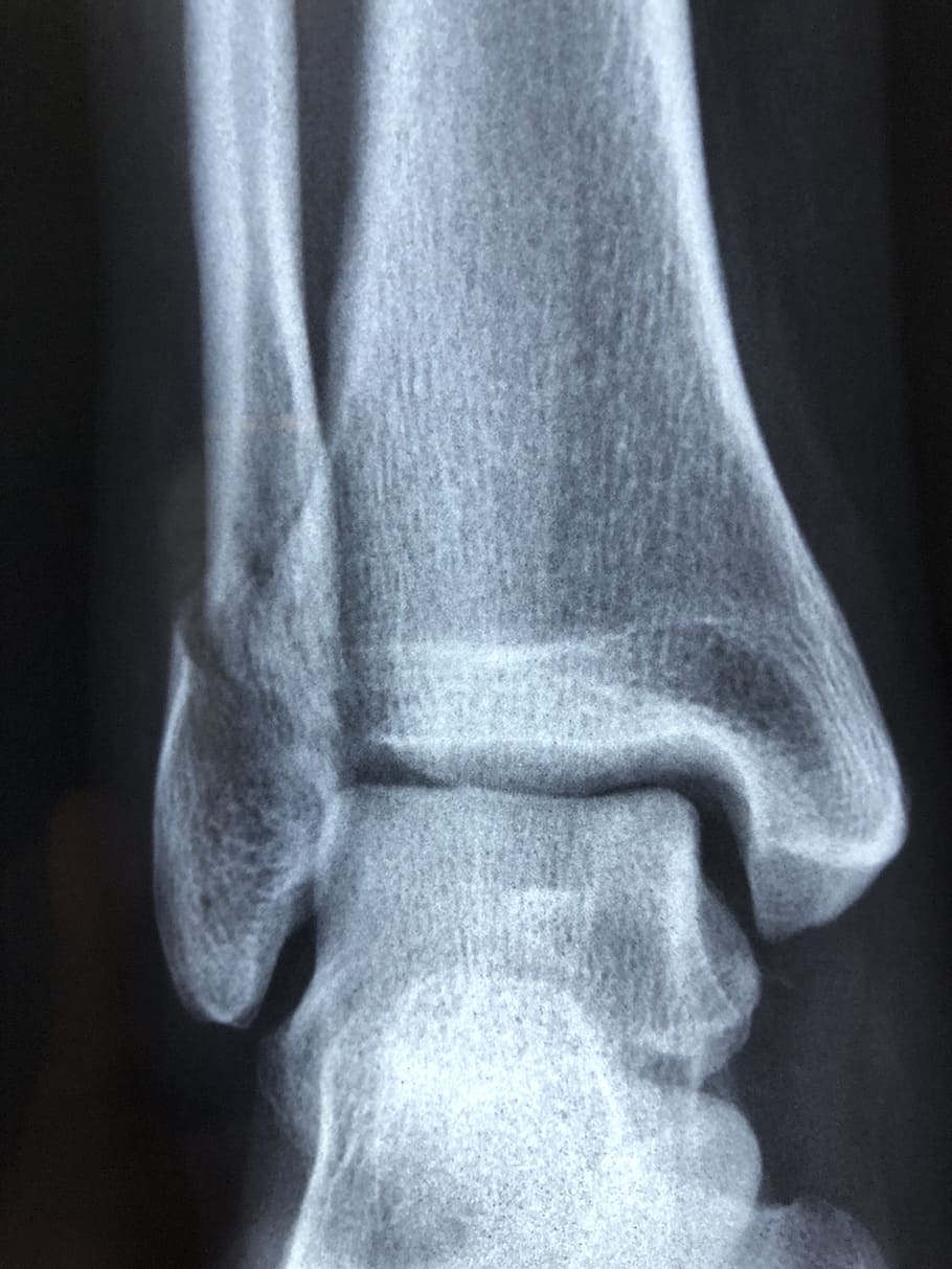 Bone X-ray Result, Radiography, Diagnosis, Anatomy, - Ankle Avulsion - HD Wallpaper 