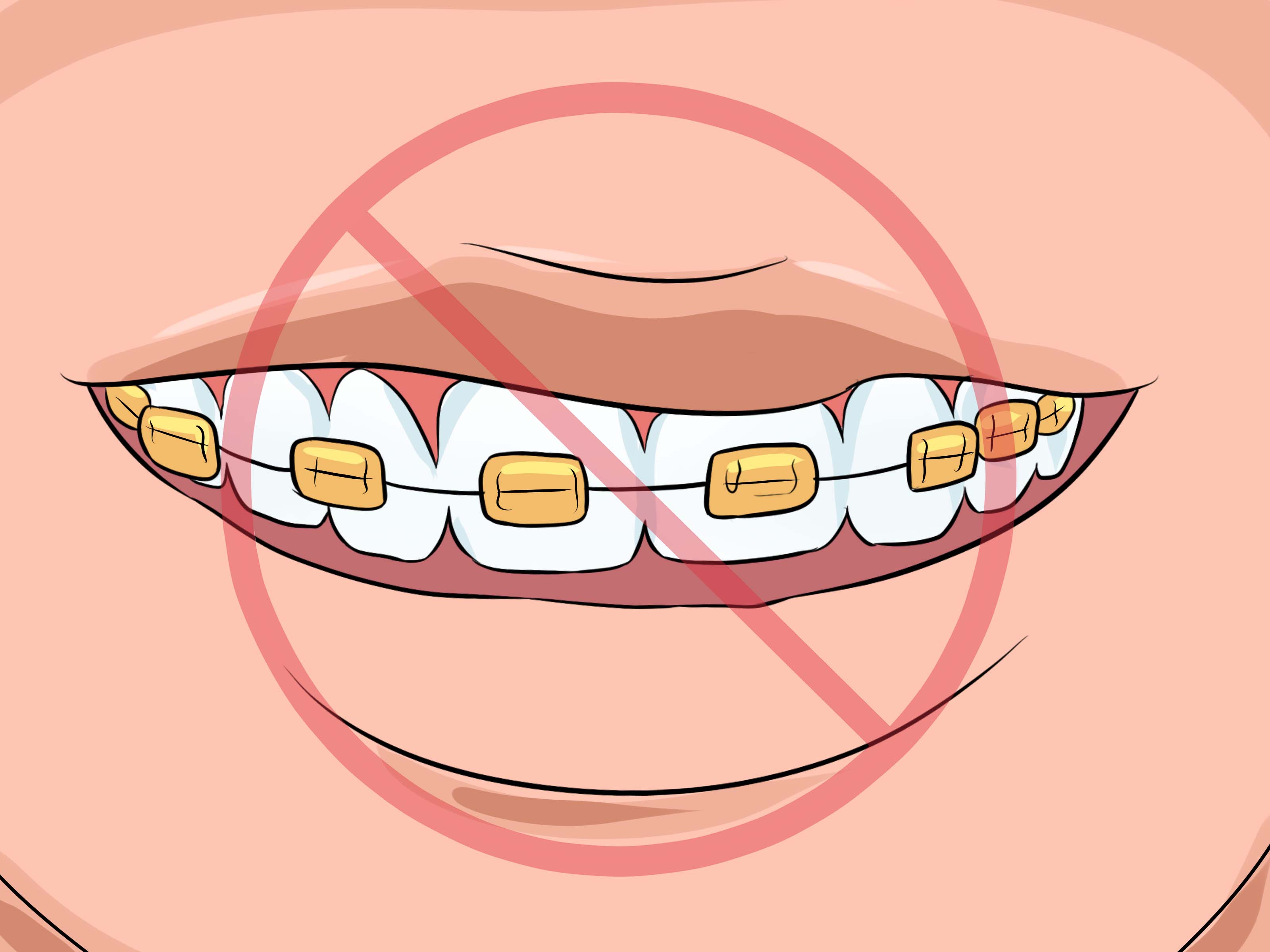 Image Titled Choose The Color Of Your Braces Step - No Color Braces - HD Wallpaper 