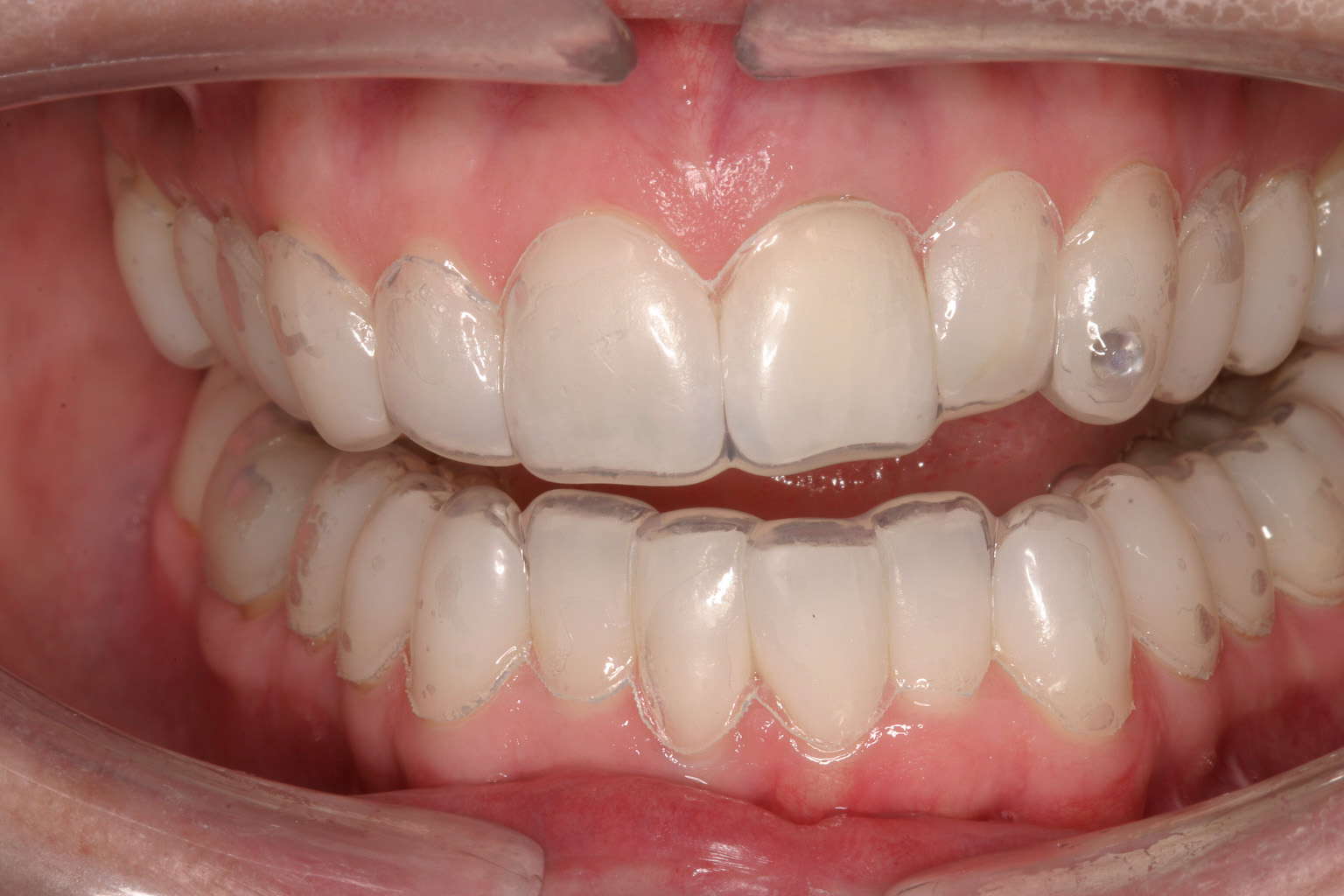 Custom Made Bleaching Trays Are Made And Worn For - Bleaching Your Teeth - HD Wallpaper 