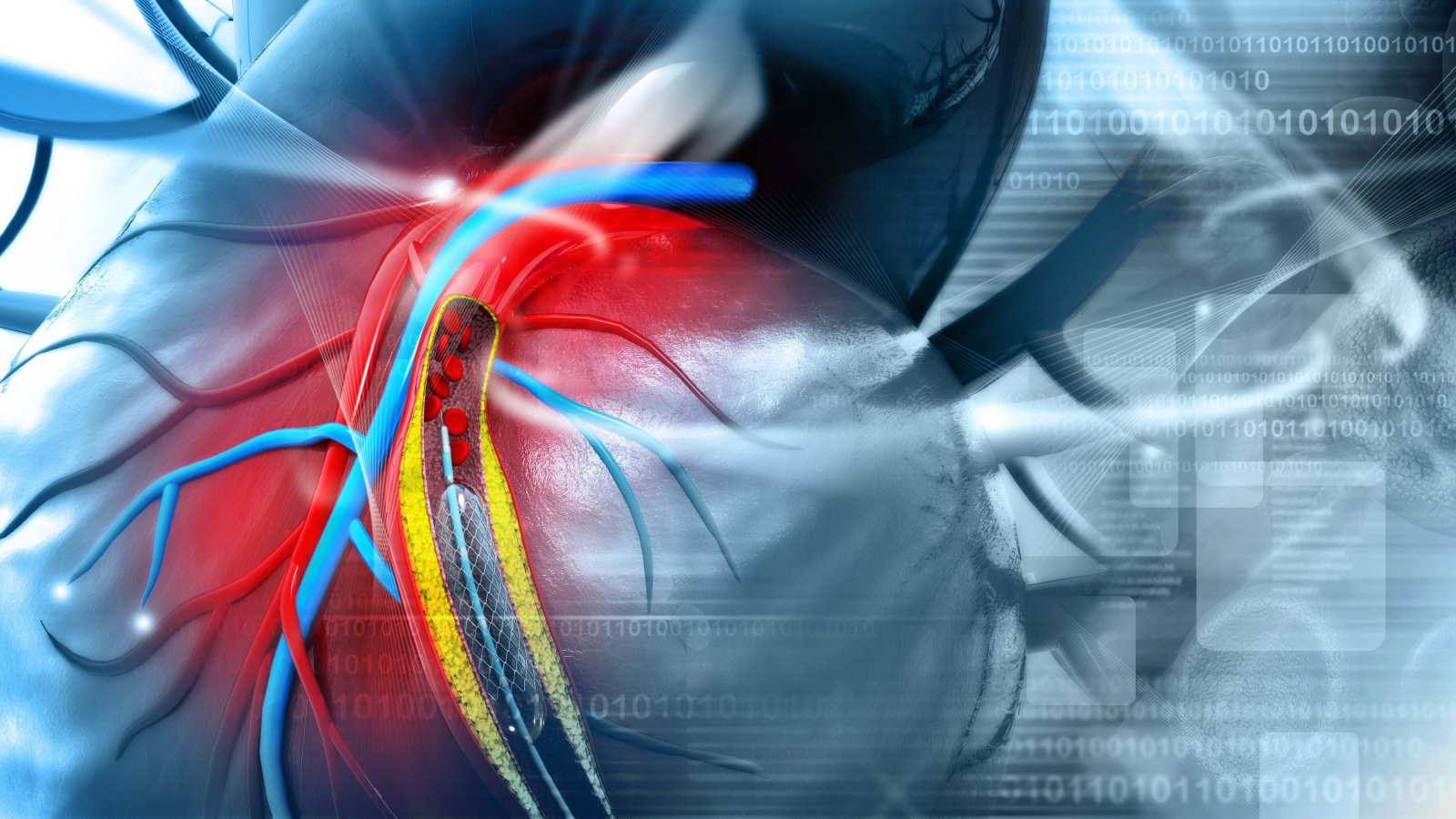 Repeat Revascularization - HD Wallpaper 