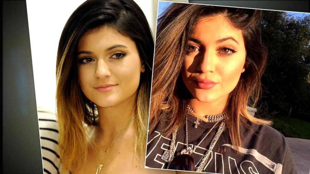 Kylie Jenner Took Out Lip Filler - HD Wallpaper 