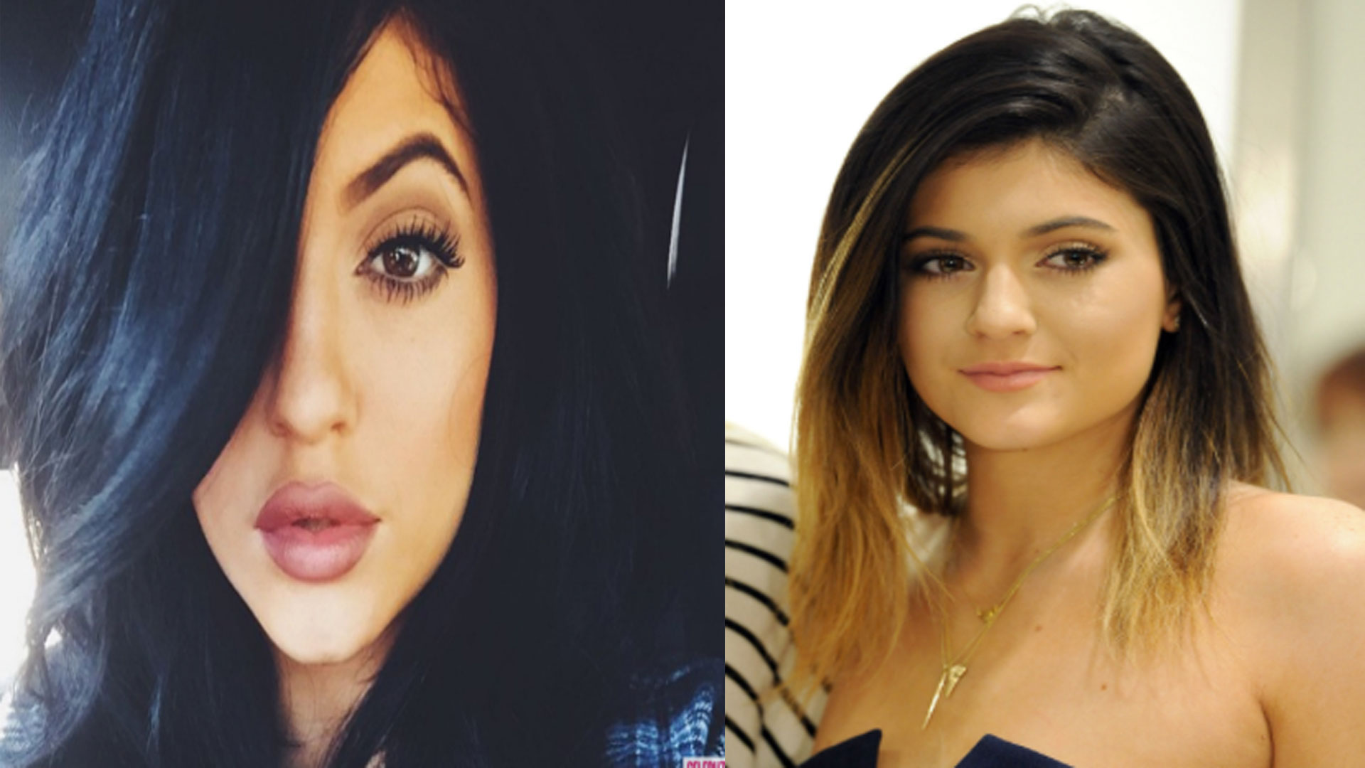 Kylie Jenner’s Lips Now In Comparison To A Couple Years - Facelift Before And After On Young People - HD Wallpaper 