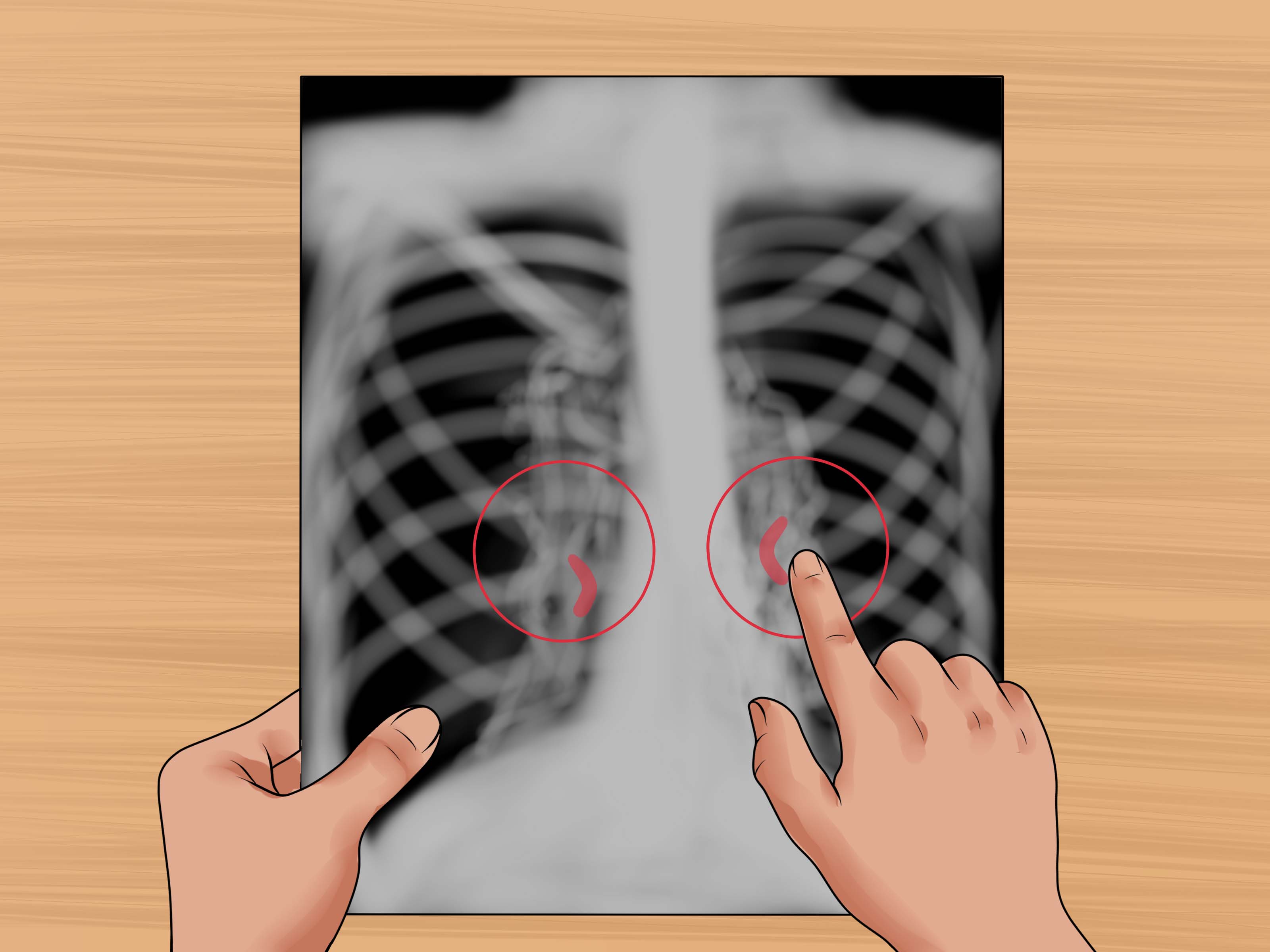 Image Titled Read A Chest X Ray Step - صورة X Ray للصدر - HD Wallpaper 