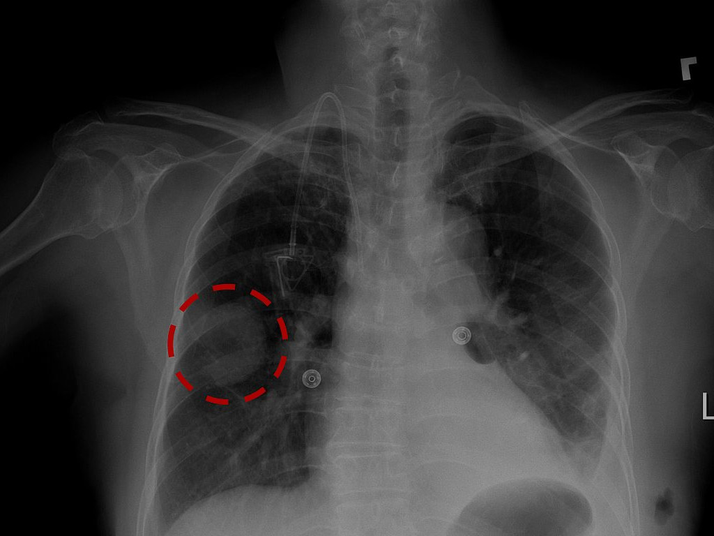 Blog-image - Pneumonia X Ray - HD Wallpaper 