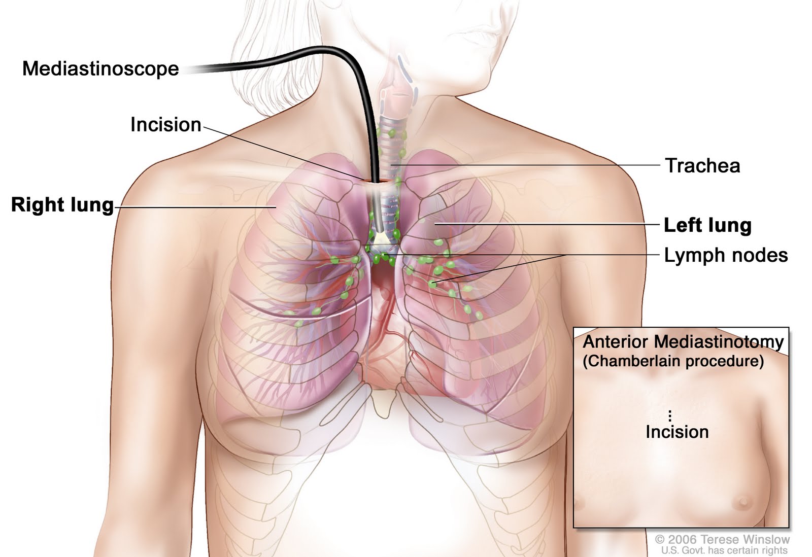Chamberlain Procedure - HD Wallpaper 